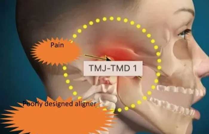 Self Ligating Braces